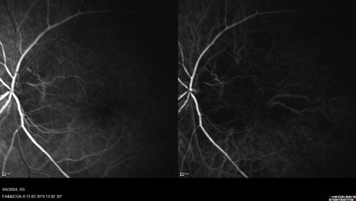 Peripapillary CNVM No Treatment
85 year old with peripapillary CNVM watched for many years.
