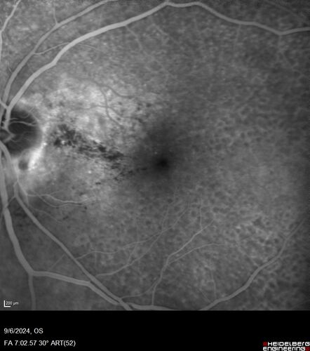 Peripapillary CNVM No Treatment
85 year old with peripapillary CNVM watched for many years.
