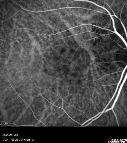Peripapillary CNVM No Treatment
85 year old with peripapillary CNVM watched for many years.
