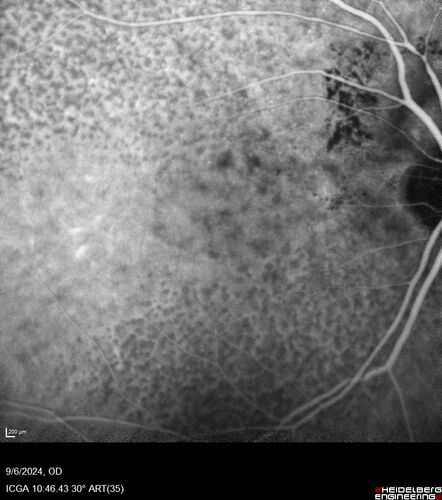 Peripapillary CNVM No Treatment
85 year old with peripapillary CNVM watched for many years.
