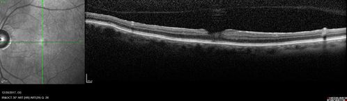 Prefoveal Opercula and early Lamellar Macular Hole
73 year old man with 20/32 vision and pre-foveal opercula.  The OCT shows very early lamellar hole with lamellar hole epiretinal proliferation
