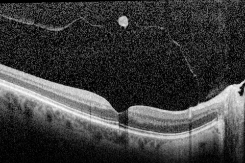 Prefoveal Opercula after Aborted Stage 2 Macular Hole - Present for 1 Year - VA 20/20 - OCT
This pleasant 61-year-old man had a small Stage 2 macular hole, which spontaneously close 12 months ago. He is still bothered by a pre-foveal opercula. OD 20/20. 
