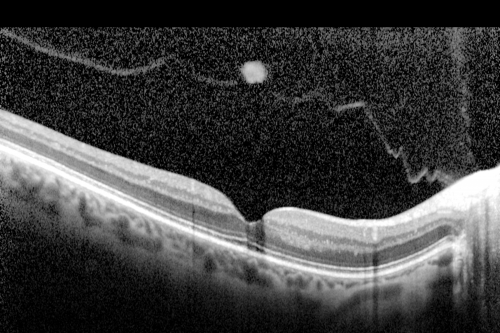 Prefoveal Opercula after Aborted Stage 2 Macular Hole - Present for 1 Year - VA 20/20 - OCT
This pleasant 61-year-old man had a small Stage 2 macular hole, which spontaneously close 12 months ago. He is still bothered by a pre-foveal opercula. OD 20/20. 
