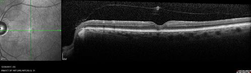 Prefoveal Opercula and early Lamellar Macular Hole
73 year old man with 20/32 vision and pre-foveal opercula.  The OCT shows very early lamellar hole with lamellar hole epiretinal proliferation
