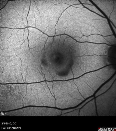 Pre-retinal hemorrhage following Posterior Vitreous Detachment (separation - PVD)
68 year old woman with acute PVD OD and new preretinal hemorrhage - also there is a macular nevus
