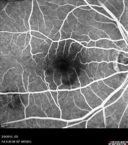 Pre-retinal hemorrhage following Posterior Vitreous Detachment (separation - PVD)
68 year old woman with acute PVD OD and new preretinal hemorrhage - also there is a macular nevus
