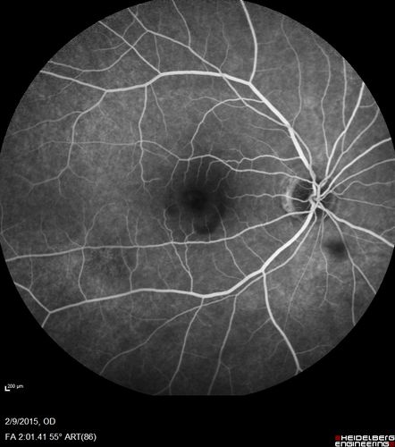 Pre-retinal hemorrhage following Posterior Vitreous Detachment (separation - PVD)
68 year old woman with acute PVD OD and new preretinal hemorrhage - also there is a macular nevus
