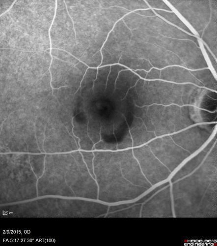 Pre-retinal hemorrhage following Posterior Vitreous Detachment (separation - PVD)
68 year old woman with acute PVD OD and new preretinal hemorrhage - also there is a macular nevus
