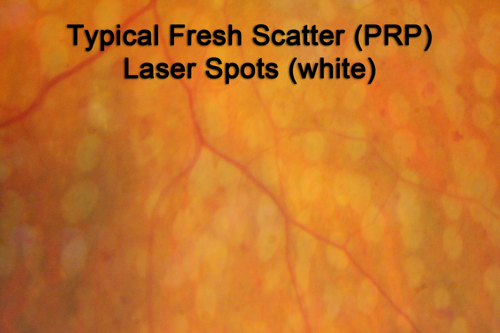 Panretinal (Scatter) Photocoagulation (Fresh)

