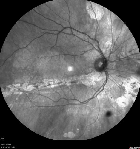 Spontaneously Re-attached Asymptomatic Chronic Retinal Detachment
47 year old female  The vision has been gradually worsening for a few years.  The two eyes have always been different. She has no knowledge of having had a retinal detachment - She now has mild CME.
VA OD: Dcc20/32 NscJ2
VA OS: Dcc20/20 NscJ1

