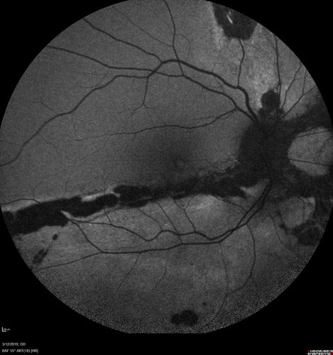 Spontaneously Re-attached Asymptomatic Chronic Retinal Detachment
47 year old female  The vision has been gradually worsening for a few years.  The two eyes have always been different. She has no knowledge of having had a retinal detachment - She now has mild CME.
VA OD: Dcc20/32 NscJ2
VA OS: Dcc20/20 NscJ1
