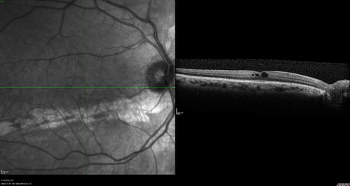 Spontaneously Re-attached Asymptomatic Chronic Retinal Detachment
47 year old female  The vision has been gradually worsening for a few years.  The two eyes have always been different. She has no knowledge of having had a retinal detachment - She now has mild CME.
VA OD: Dcc20/32 NscJ2
VA OS: Dcc20/20 NscJ1
