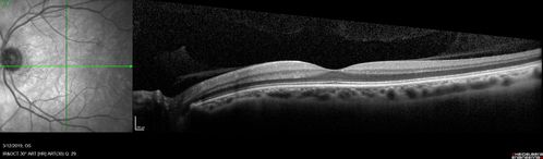 Spontaneously Re-attached Asymptomatic Chronic Retinal Detachment
47 year old female  The vision has been gradually worsening for a few years.  The two eyes have always been different. She has no knowledge of having had a retinal detachment - She now has mild CME.
VA OD: Dcc20/32 NscJ2
VA OS: Dcc20/20 NscJ1
