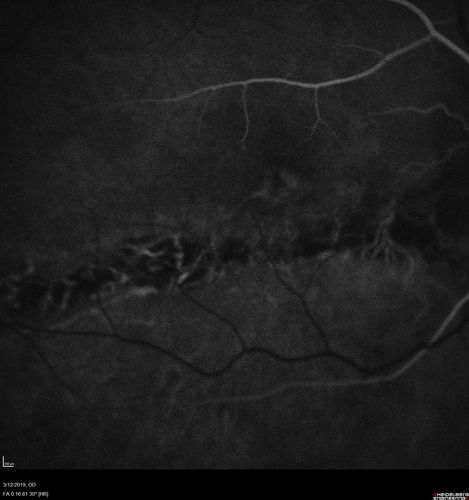 Spontaneously Re-attached Asymptomatic Chronic Retinal Detachment
47 year old female  The vision has been gradually worsening for a few years.  The two eyes have always been different. She has no knowledge of having had a retinal detachment - She now has mild CME.
VA OD: Dcc20/32 NscJ2
VA OS: Dcc20/20 NscJ1
