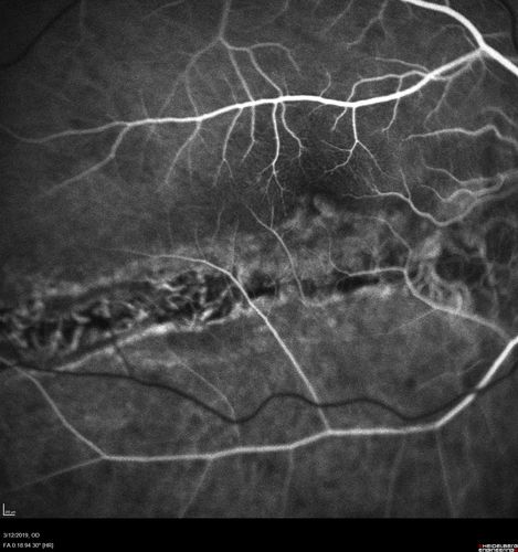 Spontaneously Re-attached Asymptomatic Chronic Retinal Detachment
47 year old female  The vision has been gradually worsening for a few years.  The two eyes have always been different. She has no knowledge of having had a retinal detachment - She now has mild CME.
VA OD: Dcc20/32 NscJ2
VA OS: Dcc20/20 NscJ1
