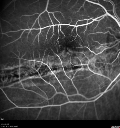 Spontaneously Re-attached Asymptomatic Chronic Retinal Detachment
47 year old female  The vision has been gradually worsening for a few years.  The two eyes have always been different. She has no knowledge of having had a retinal detachment - She now has mild CME.
VA OD: Dcc20/32 NscJ2
VA OS: Dcc20/20 NscJ1

