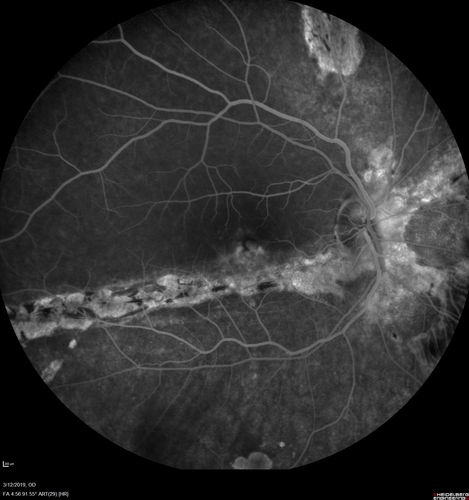 Spontaneously Re-attached Asymptomatic Chronic Retinal Detachment
47 year old female  The vision has been gradually worsening for a few years.  The two eyes have always been different. She has no knowledge of having had a retinal detachment - She now has mild CME.
VA OD: Dcc20/32 NscJ2
VA OS: Dcc20/20 NscJ1
