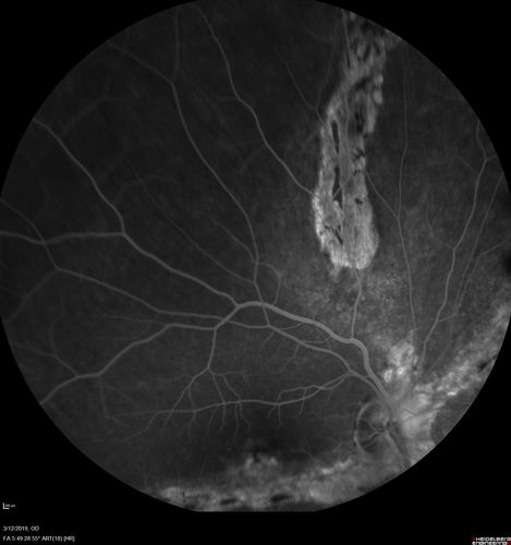 Spontaneously Re-attached Asymptomatic Chronic Retinal Detachment
47 year old female  The vision has been gradually worsening for a few years.  The two eyes have always been different. She has no knowledge of having had a retinal detachment - She now has mild CME.
VA OD: Dcc20/32 NscJ2
VA OS: Dcc20/20 NscJ1
