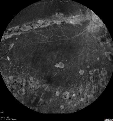 Spontaneously Re-attached Asymptomatic Chronic Retinal Detachment
47 year old female  The vision has been gradually worsening for a few years.  The two eyes have always been different. She has no knowledge of having had a retinal detachment - She now has mild CME.
VA OD: Dcc20/32 NscJ2
VA OS: Dcc20/20 NscJ1
