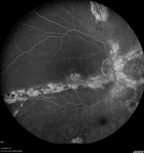 Spontaneously Re-attached Asymptomatic Chronic Retinal Detachment
47 year old female  The vision has been gradually worsening for a few years.  The two eyes have always been different. She has no knowledge of having had a retinal detachment - She now has mild CME.
VA OD: Dcc20/32 NscJ2
VA OS: Dcc20/20 NscJ1
