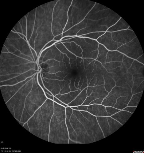 Spontaneously Re-attached Asymptomatic Chronic Retinal Detachment
47 year old female  The vision has been gradually worsening for a few years.  The two eyes have always been different. She has no knowledge of having had a retinal detachment - She now has mild CME.
VA OD: Dcc20/32 NscJ2
VA OS: Dcc20/20 NscJ1
