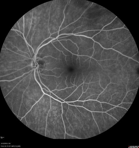Spontaneously Re-attached Asymptomatic Chronic Retinal Detachment
47 year old female  The vision has been gradually worsening for a few years.  The two eyes have always been different. She has no knowledge of having had a retinal detachment - She now has mild CME.
VA OD: Dcc20/32 NscJ2
VA OS: Dcc20/20 NscJ1
