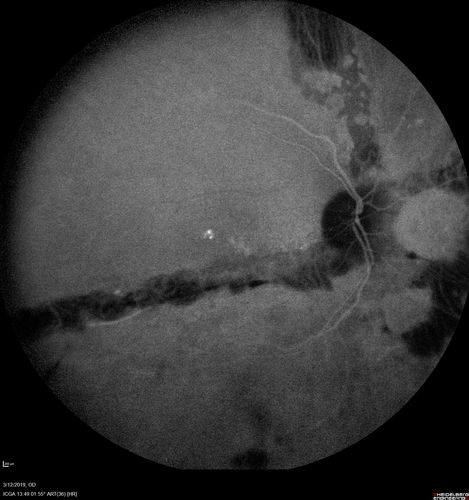 Spontaneously Re-attached Asymptomatic Chronic Retinal Detachment
47 year old female  The vision has been gradually worsening for a few years.  The two eyes have always been different. She has no knowledge of having had a retinal detachment - She now has mild CME.
VA OD: Dcc20/32 NscJ2
VA OS: Dcc20/20 NscJ1
