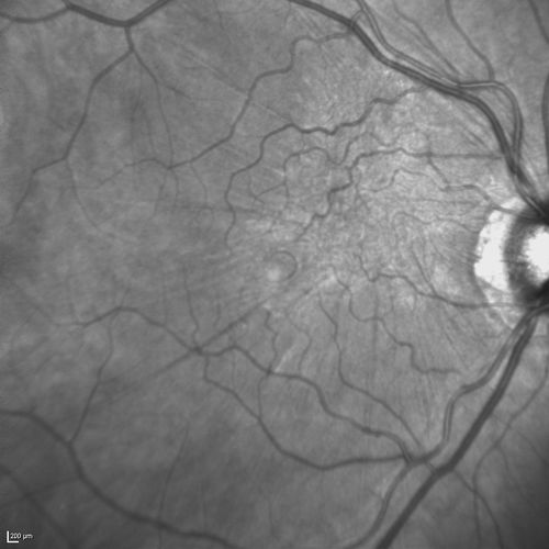 Psuedomacular Hole - Epiretinal Membrane - Vision unchanged 20/40 for 6 months
