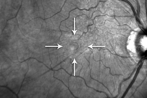 Psuedomacular Hole - Epiretinal Membrane - Vision unchanged 20/40 for 6 months
