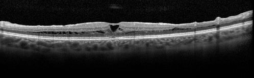 Severe Macular Pucker
57 year old female with 20/200 vision and dense macular pucker.  Vision improved to 20/50 within about 6 months of surgery.
