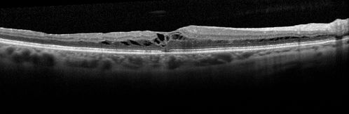 Severe Macular Pucker
57 year old female with 20/200 vision and dense macular pucker.  Vision improved to 20/50 within about 6 months of surgery.
