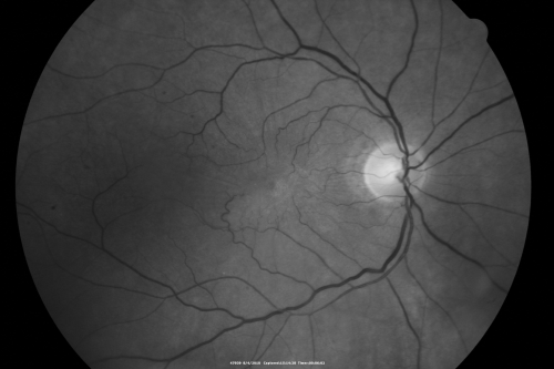 Macular Pucker Pre-OP 20/200 Macular Pucker Pre-OP 20/200 
