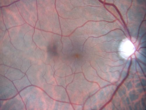 Macular Pucker - 1 year after Vitrectomy - 20/25 Vision - Postoperative Images
60-year-old man had vitrectomy for a macular pucker in the right eye a year ago.  His vision is good.

VISUAL ACUITY:  Vision OD is 20/25 Eye is now pseudophakic
