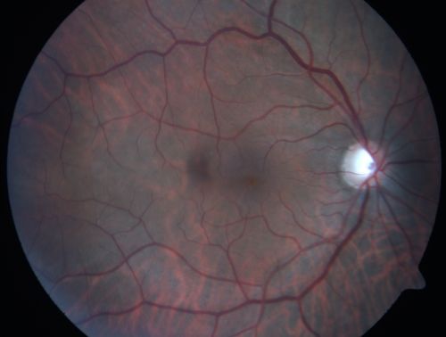 Macular Pucker - 1 year after Vitrectomy - 20/25 Vision - Postoperative Images
60-year-old man had vitrectomy for a macular pucker in the right eye a year ago.  His vision is good.

VISUAL ACUITY:  Vision OD is 20/25 Eye is now pseudophakic
