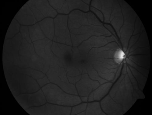 Macular Pucker - 1 year after Vitrectomy - 20/25 Vision - Postoperative Images
60-year-old man had vitrectomy for a macular pucker in the right eye a year ago.  His vision is good.

VISUAL ACUITY:  Vision OD is 20/25 Eye is now pseudophakic
