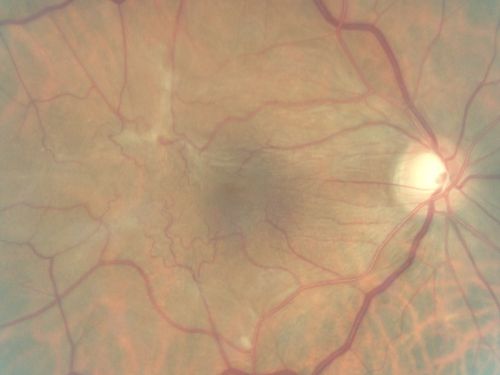 Macular Pucker - 3 Weeks Vision Loss - 20/50 Vision - Preoperative Images
PREOP:
59-year-old man new onset floaters about a year ago.  Subsequent to that his vision was not quite right in the right eye and then he noticed, starting about three weeks ago, substantial change in the vision.   VISUAL ACUITY:  Vision OD is 20/50, OS is 20/16
