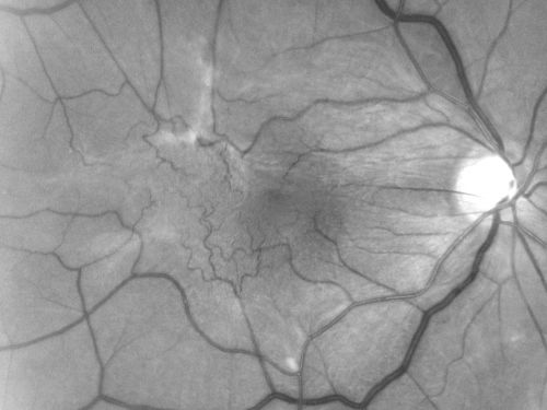 Macular Pucker - 3 Weeks Vision Loss - 20/50 Vision - Preoperative Images
PREOP:
59-year-old man new onset floaters about a year ago.  Subsequent to that his vision was not quite right in the right eye and then he noticed, starting about three weeks ago, substantial change in the vision.   VISUAL ACUITY:  Vision OD is 20/50, OS is 20/16

