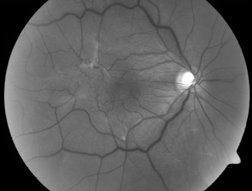 Macular Pucker - 3 Weeks Vision Loss - 20/50 Vision - Preoperative Images
PREOP:
59-year-old man new onset floaters about a year ago.  Subsequent to that his vision was not quite right in the right eye and then he noticed, starting about three weeks ago, substantial change in the vision.   VISUAL ACUITY:  Vision OD is 20/50, OS is 20/16
