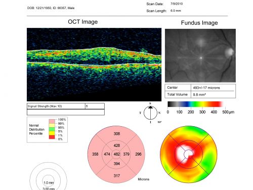 Macular Pucker - 3 Weeks Vision Loss - 20/50 Vision - Preoperative Images
PREOP:
59-year-old man new onset floaters about a year ago.  Subsequent to that his vision was not quite right in the right eye and then he noticed, starting about three weeks ago, substantial change in the vision.   VISUAL ACUITY:  Vision OD is 20/50, OS is 20/16
