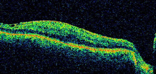 Macular Pucker - 3 Weeks Vision Loss - 20/50 Vision - Preoperative Images
PREOP:
59-year-old man new onset floaters about a year ago.  Subsequent to that his vision was not quite right in the right eye and then he noticed, starting about three weeks ago, substantial change in the vision.   VISUAL ACUITY:  Vision OD is 20/50, OS is 20/16
