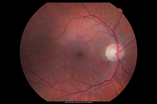 Macular Pucker Post-OP 20/30
