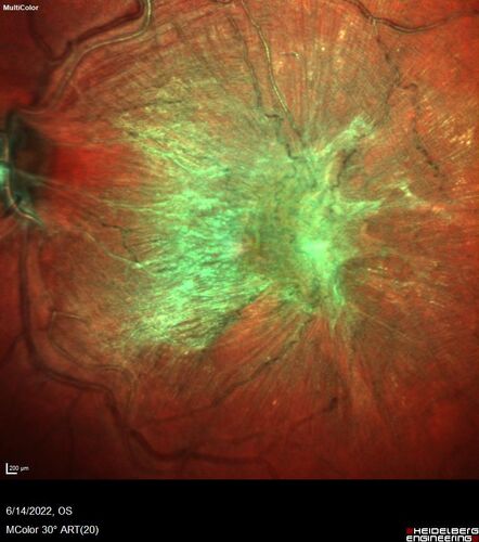 Macular pucker in the left eye
Vision was 20/125 pre-op and 20/25 post-op.

