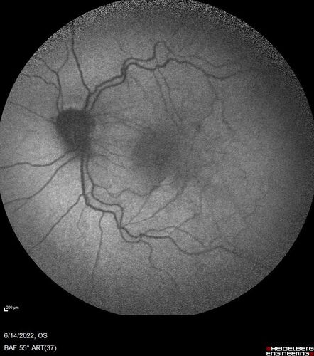 Macular pucker in the left eye
Vision was 20/125 pre-op and 20/25 post-op.
