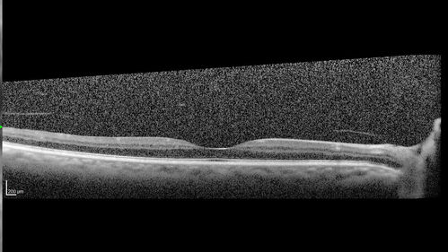 Macular pucker in the left eye
Vision was 20/125 pre-op and 20/25 post-op.
