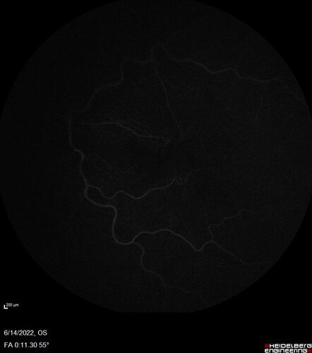 Macular pucker in the left eye
Vision was 20/125 pre-op and 20/25 post-op.
