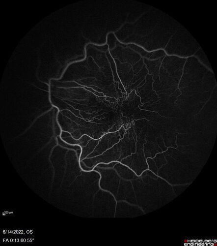 Macular pucker in the left eye
Vision was 20/125 pre-op and 20/25 post-op.
