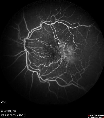 Macular pucker in the left eye
Vision was 20/125 pre-op and 20/25 post-op.
