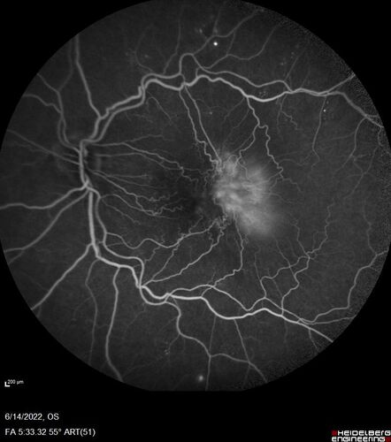 Macular pucker in the left eye
Vision was 20/125 pre-op and 20/25 post-op.
