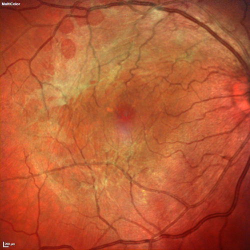 Macular Pucker 20/40 vision - minimal symptoms for 1 year Right eye
Multicolor
