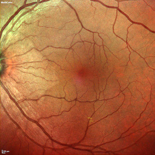 Macular Pucker 20/40 vision - minimal symptoms for 1 year Right eye
Multicolor
